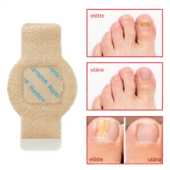 Elaimei™  Fungal Nail Patches