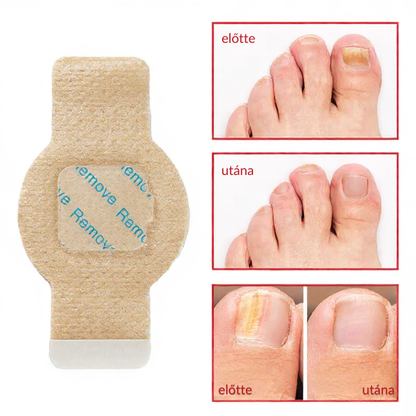 Elaimei™  Fungal Nail Patches